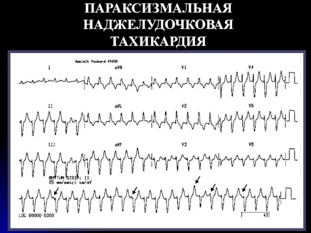 ПАРАКСИЗМАЛЬНАЯ НАДЖЕЛУДОЧКОВАЯ ТАХИКАРДИЯ