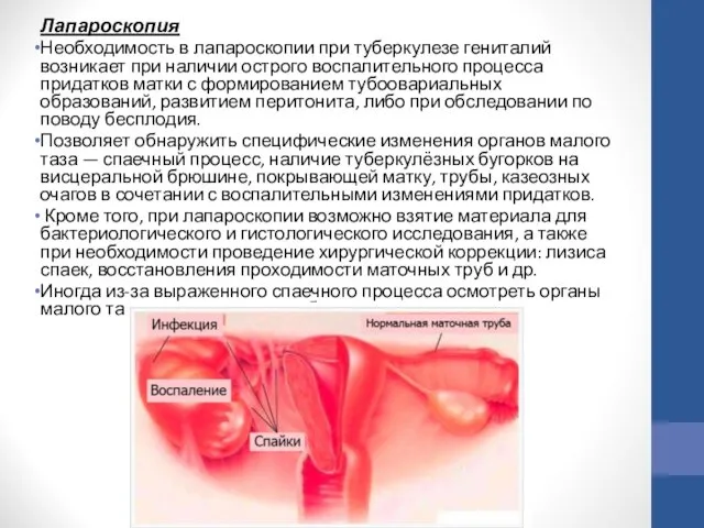 Лапароскопия Необходимость в лапароскопии при туберкулезе гениталий возникает при наличии острого