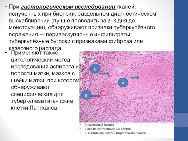 При гистологическом исследовании тканей, полученных при биопсии, раздельном диагностическом выскабливании (лучше