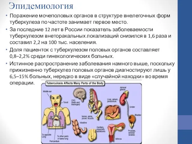 Эпидемиология Поражение мочеполовых органов в структуре внелегочных форм туберкулеза по частоте