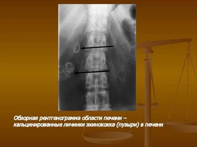 Обзорная рентгенограмма области печени – кальцинированные личинки эхинококка (пузыри) в печени