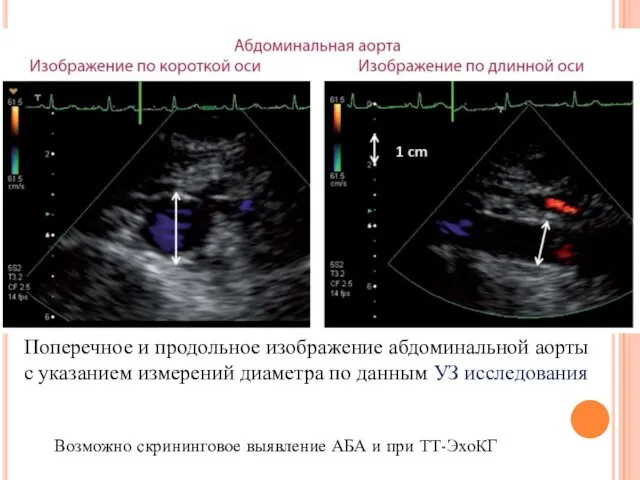 Поперечное и продольное изображение абдоминальной аорты с указанием измерений диаметра по