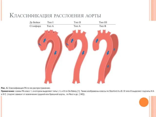 Классификация расслоения аорты