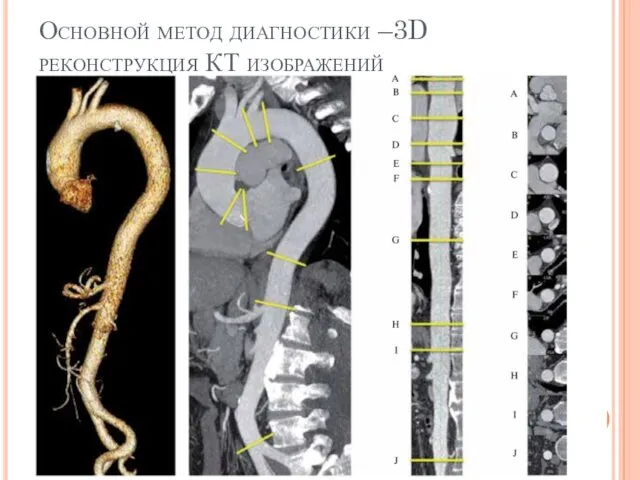 Основной метод диагностики –3D реконструкция КТ изображений