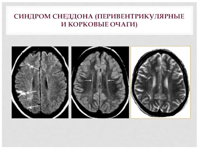 СИНДРОМ СНЕДДОНА (ПЕРИВЕНТРИКУЛЯРНЫЕ И КОРКОВЫЕ ОЧАГИ)