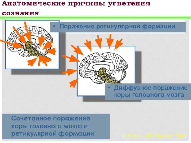 Сочетанное поражение коры головного мозга и ретикулярной формации F. Plum, L.B.