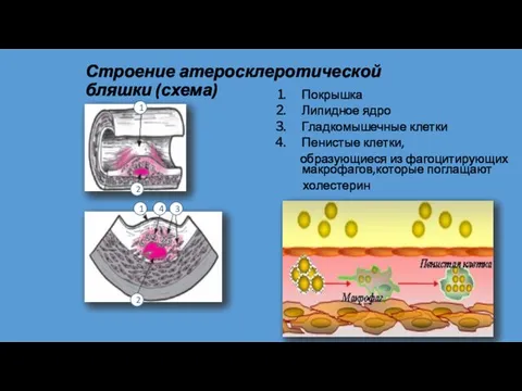 Строение атеросклеротической бляшки (схема) Покрышка Липидное ядро Гладкомышечные клетки Пенистые клетки,