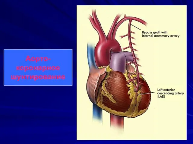 Аорто-коронарное шунтирование