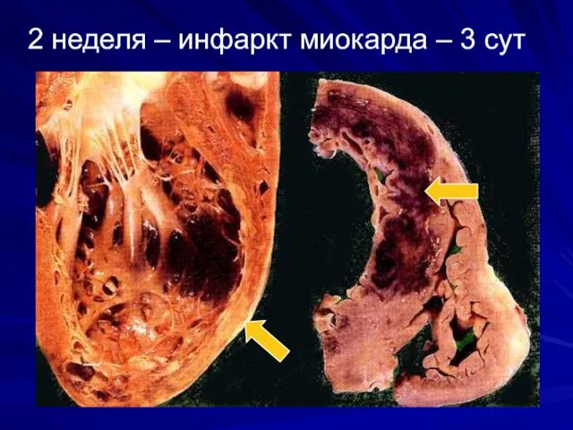 2 неделя – инфаркт миокарда – 3 сут