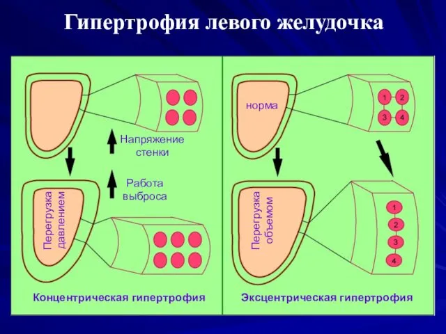 Гипертрофия левого желудочка