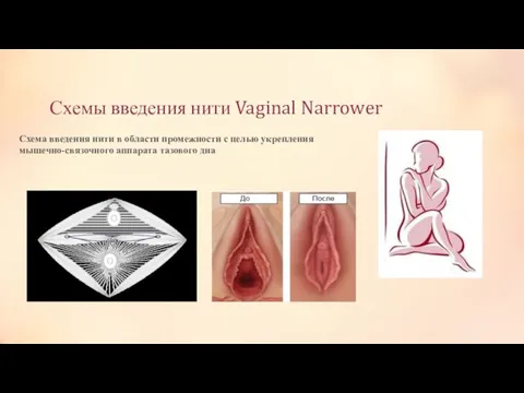 Схемы введения нити Vaginal Narrower Схема введения нити в области промежности