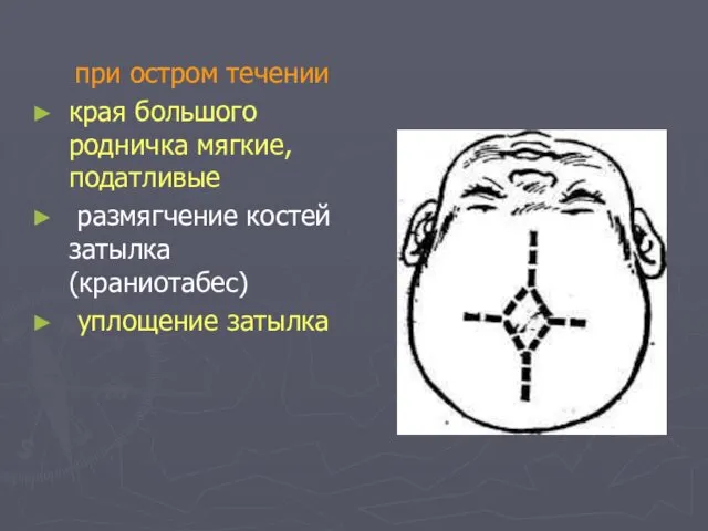 при остром течении края большого родничка мягкие, податливые размягчение костей затылка (краниотабес) уплощение затылка