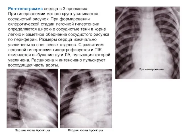 Рентгенограмма сердца в 3 проекциях: При гиперволемии малого круга усиливается сосудистый