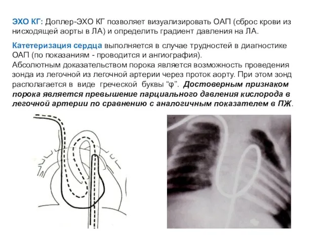 ЭХО КГ: Доплер-ЭХО КГ позволяет визуализировать ОАП (сброс крови из нисходящей