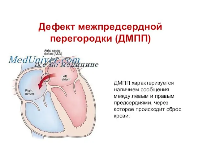 Дефект межпредсердной перегородки (ДМПП) ДМПП характеризуется наличием сообщения между левым и