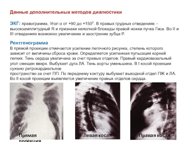 Данные дополнительных методов диагностики ЭКГ: правограмма. Угол α от +90 до