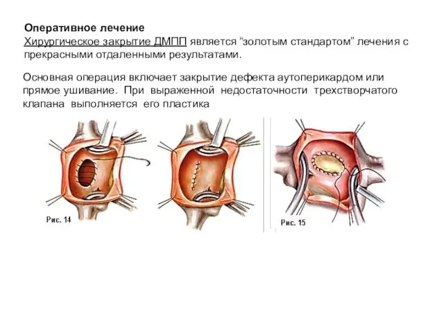 Основная операция включает закрытие дефекта аутоперикардом или прямое ушивание. При выраженной