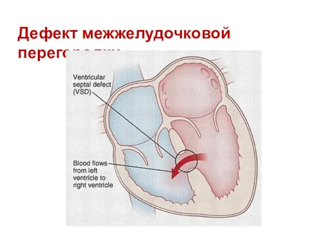 Дефект межжелудочковой перегородки