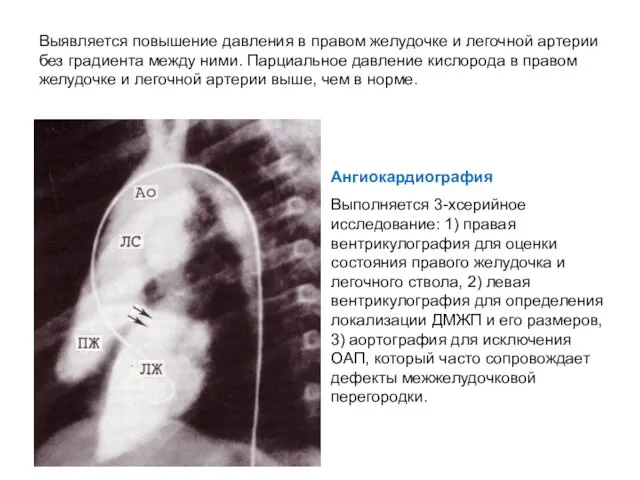 Выявляется повышение давления в правом желудочке и легочной артерии без градиента