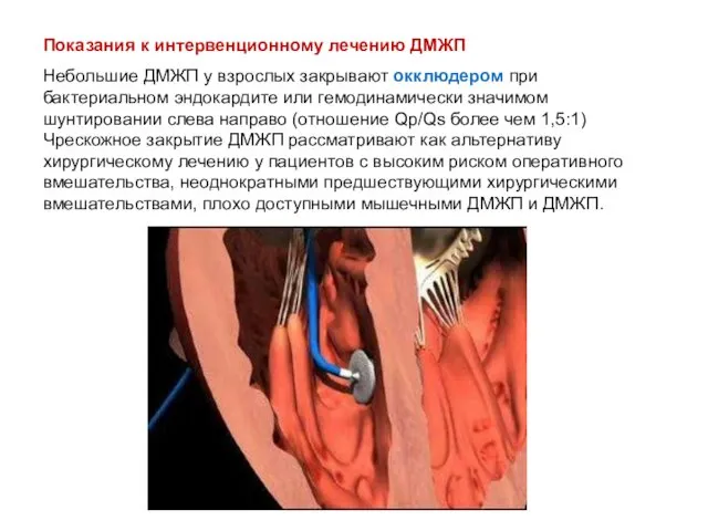 Показания к интервенционному лечению ДМЖП Небольшие ДМЖП у взрослых закрывают окклюдером