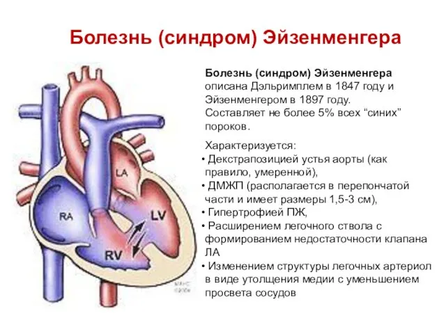 Болезнь (синдром) Эйзенменгера Болезнь (синдром) Эйзенменгера описана Дэльримплем в 1847 году