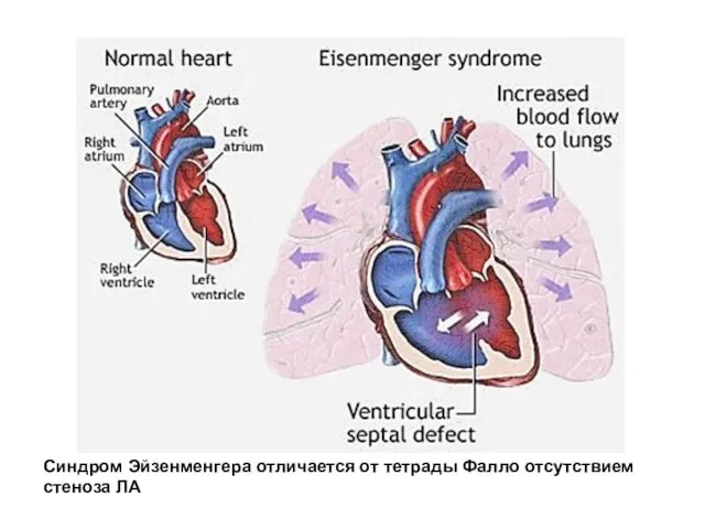 Синдром Эйзенменгера отличается от тетрады Фалло отсутствием стеноза ЛА