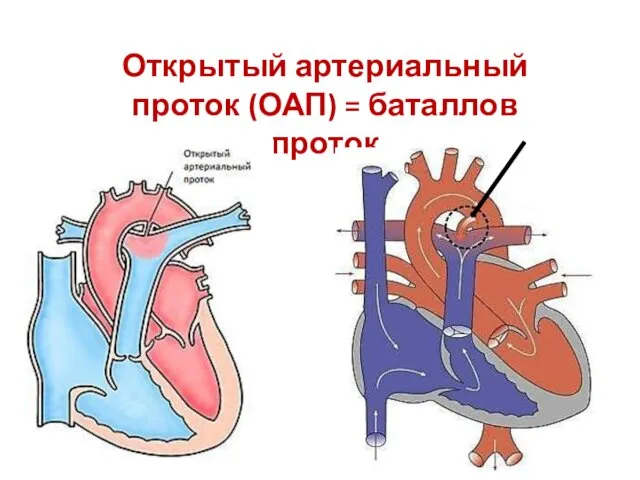 Открытый артериальный проток (ОАП) = баталлов проток