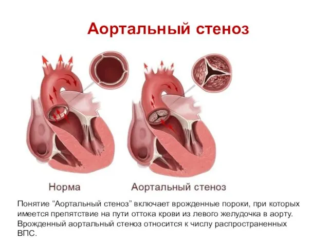 Аортальный стеноз Понятие “Аортальный стеноз” включает врожденные пороки, при которых имеется