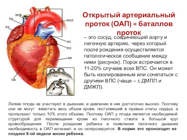 Открытый артериальный проток (ОАП) = баталлов проток – это сосуд, соединяющий