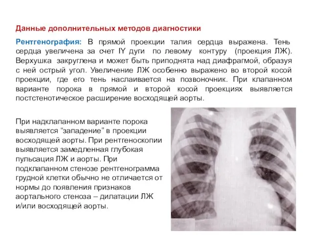 Данные дополнительных методов диагностики Рентгенография: В прямой проекции талия сердца выражена.