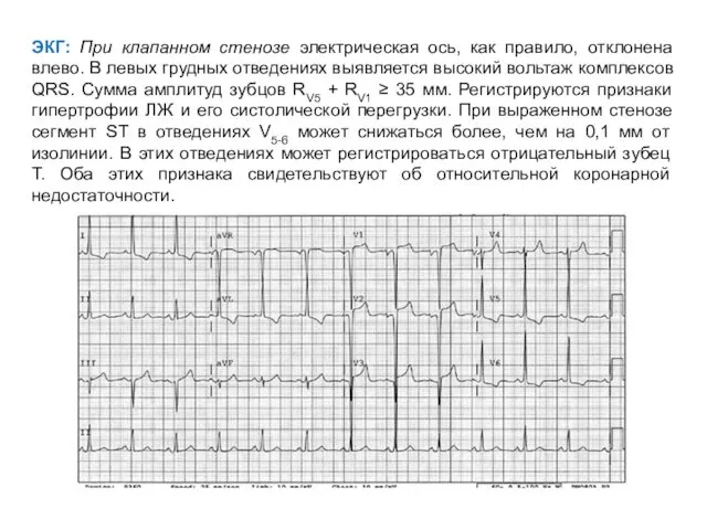 ЭКГ: При клапанном стенозе электрическая ось, как правило, отклонена влево. В