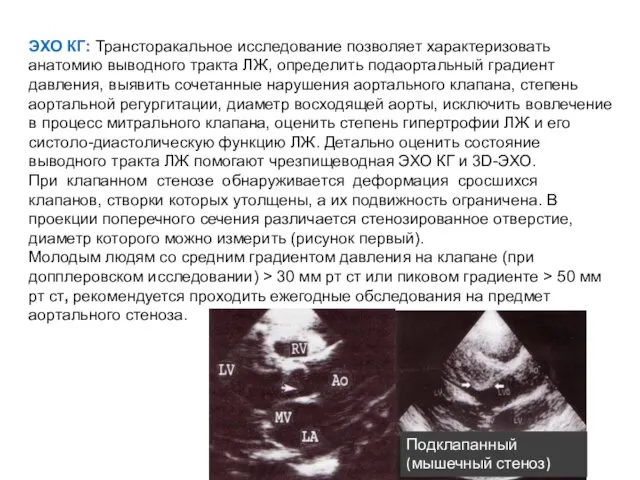 ЭХО КГ: Трансторакальное исследование позволяет характеризовать анатомию выводного тракта ЛЖ, определить