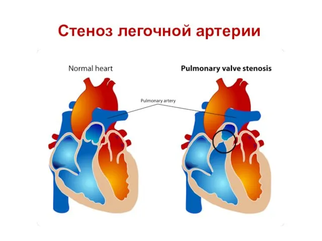 Стеноз легочной артерии