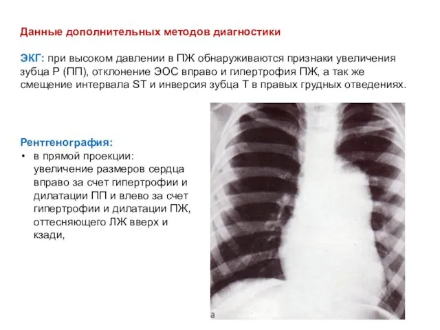 Данные дополнительных методов диагностики ЭКГ: при высоком давлении в ПЖ обнаруживаются