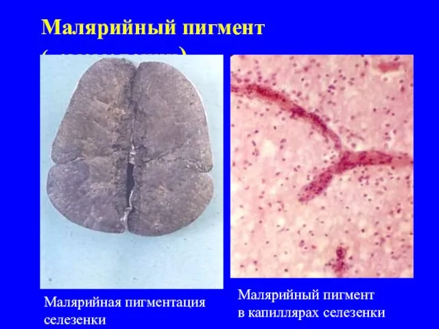 Малярийный пигмент (гемомеланин) Малярийная пигментация селезенки Малярийный пигмент в капиллярах селезенки