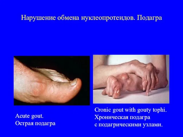 Нарушение обмена нуклеопротеидов. Подагра Аcute gout. Острая подагра Сronic gout with