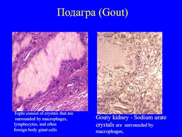 Подагра (Gout) Тophi consist of crystals that are surrounded by macrophages,