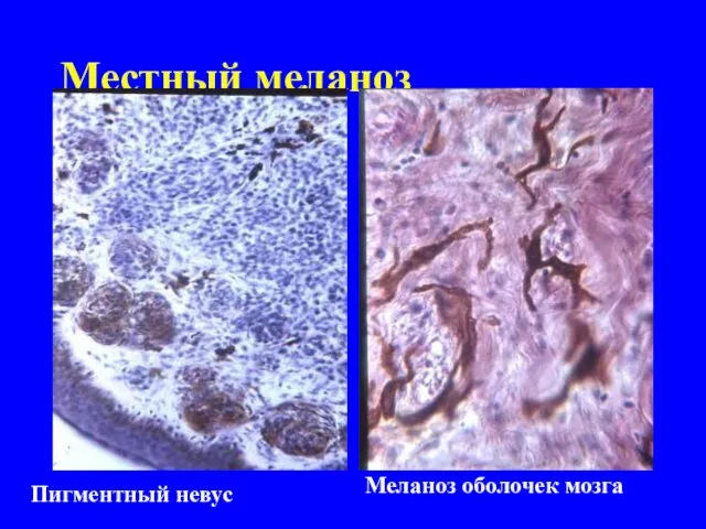 Местный меланоз Пигментный невус Меланоз оболочек мозга