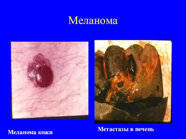 Меланома Меланома кожи Метастазы в печень