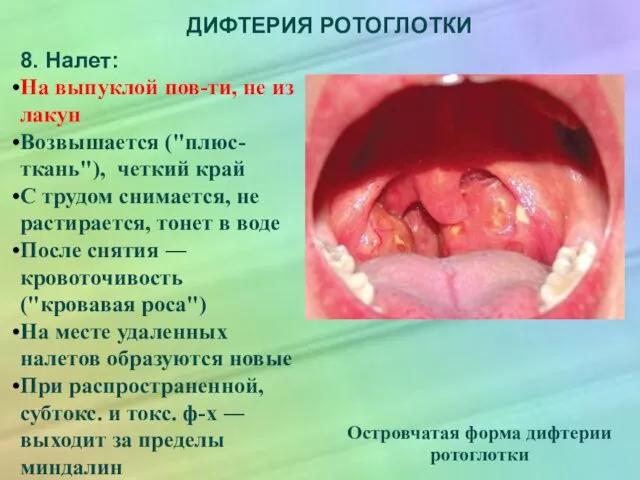 ДИФТЕРИЯ РОТОГЛОТКИ 8. Налет: На выпуклой пов-ти, не из лакун Возвышается