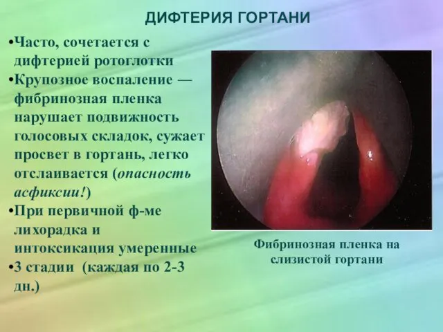 ДИФТЕРИЯ ГОРТАНИ Часто, сочетается с дифтерией ротоглотки Крупозное воспаление ― фибринозная