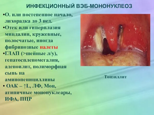 ИНФЕКЦИОННЫЙ ВЭБ-МОНОНУКЛЕОЗ О. или постепенное начало, лихорадка до 3 нед. Отек