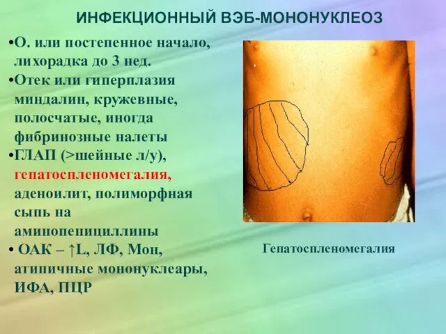 ИНФЕКЦИОННЫЙ ВЭБ-МОНОНУКЛЕОЗ О. или постепенное начало, лихорадка до 3 нед. Отек