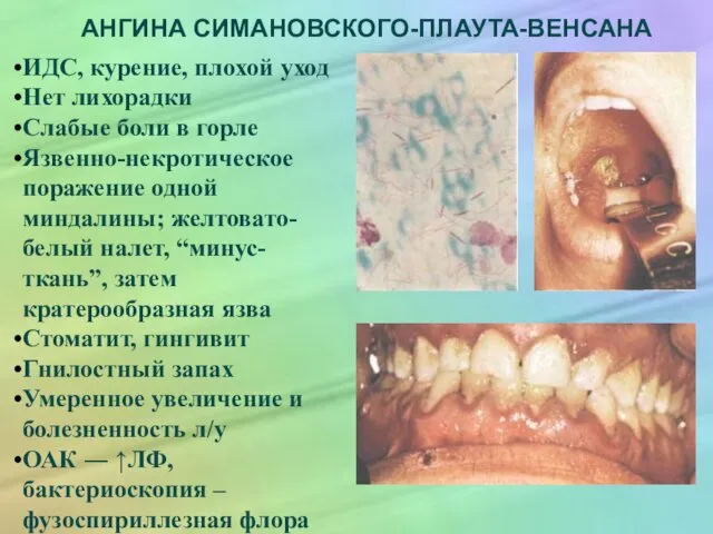 АНГИНА СИМАНОВСКОГО-ПЛАУТА-ВЕНСАНА ИДС, курение, плохой уход Нет лихорадки Слабые боли в