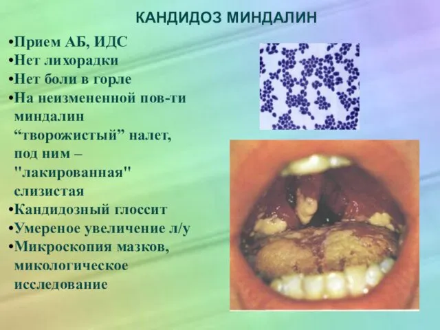 КАНДИДОЗ МИНДАЛИН Прием АБ, ИДС Нет лихорадки Нет боли в горле