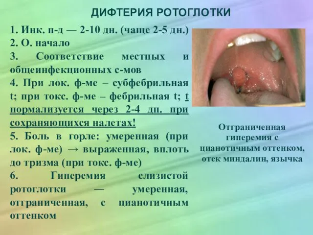 ДИФТЕРИЯ РОТОГЛОТКИ 1. Инк. п-д ― 2-10 дн. (чаще 2-5 дн.)