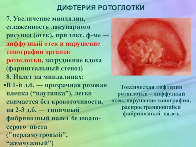 ДИФТЕРИЯ РОТОГЛОТКИ 7. Увеличение миндалин, сглаженность лакунарного рисунка (отек), при токс.