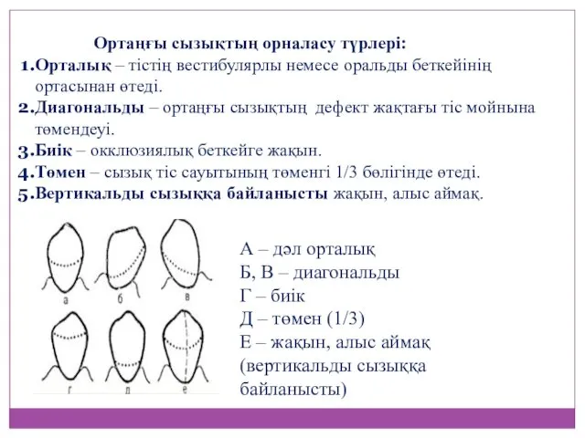 А – дәл орталық Б, В – диагональды Г – биік