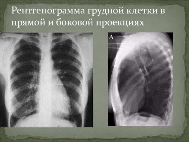 Рентгенограмма грудной клетки в прямой и боковой проекциях