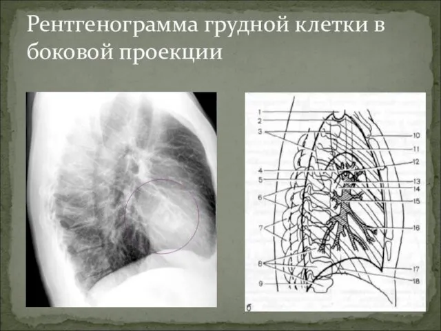 Рентгенограмма грудной клетки в боковой проекции